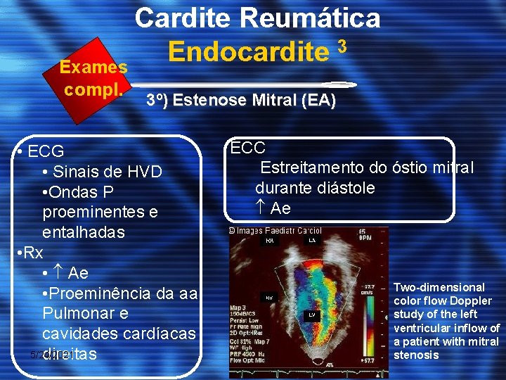 Cardite Reumática 3 Endocardite Exames compl. 3º) Estenose Mitral (EA) • ECG • Sinais
