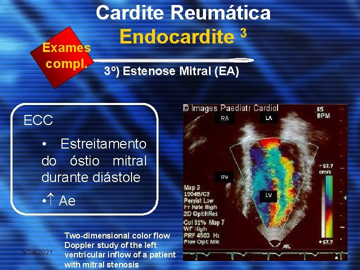 Cardite Reumática 3 Endocardite Exames compl. 3º) Estenose Mitral (EA) ECC • Estreitamento do