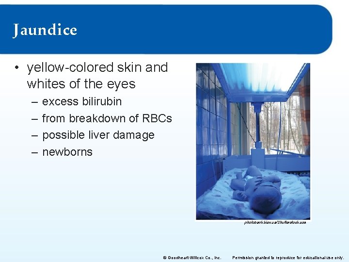 Jaundice • yellow-colored skin and whites of the eyes – – excess bilirubin from