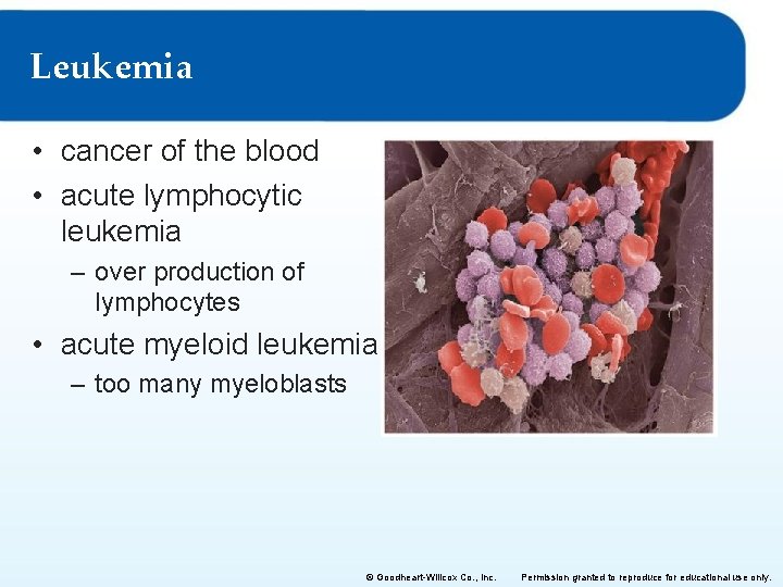 Leukemia • cancer of the blood • acute lymphocytic leukemia – over production of