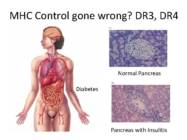 MHC Control gone wrong? DR 3, DR 4 Normal Pancreas Diabetes Pancreas with Insulitis
