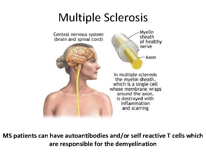 Multiple Sclerosis MS patients can have autoantibodies and/or self reactive T cells which are
