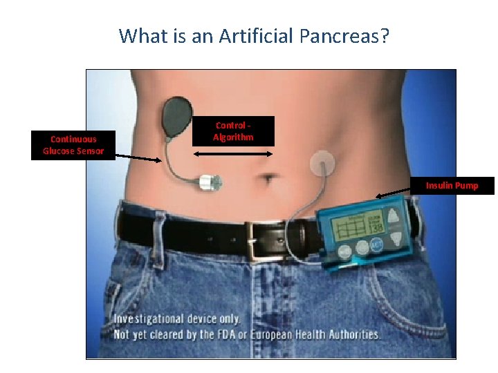 What is an Artificial Pancreas? Continuous Glucose Sensor Control Algorithm Insulin Pump 