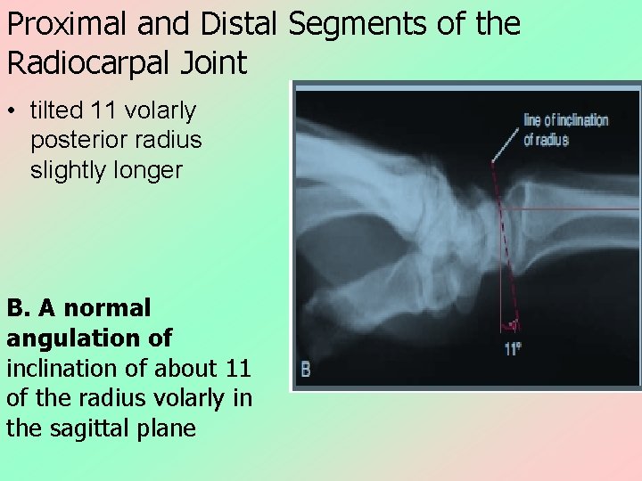 Proximal and Distal Segments of the Radiocarpal Joint • tilted 11 volarly posterior radius