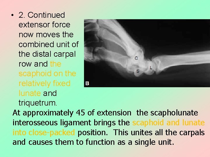  • 2. Continued extensor force now moves the combined unit of the distal