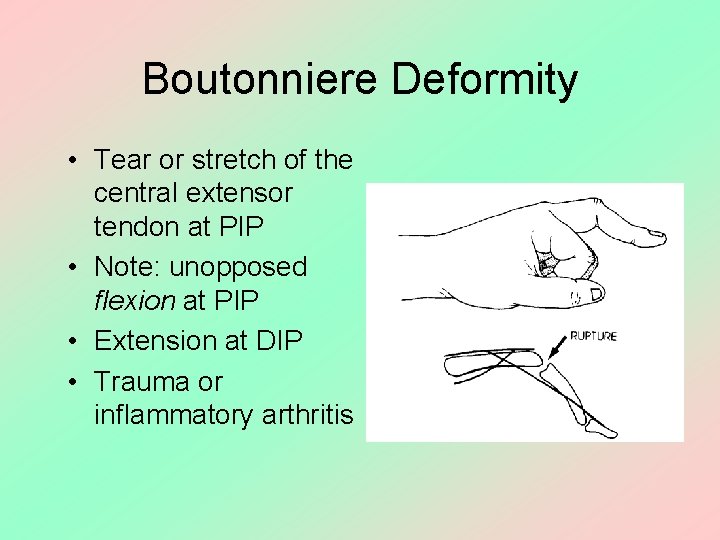 Boutonniere Deformity • Tear or stretch of the central extensor tendon at PIP •