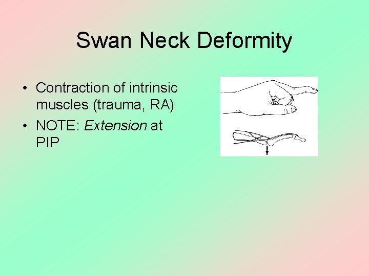Swan Neck Deformity • Contraction of intrinsic muscles (trauma, RA) • NOTE: Extension at