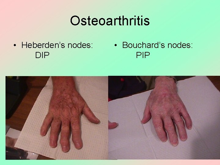Osteoarthritis • Heberden’s nodes: DIP • Bouchard’s nodes: PIP 