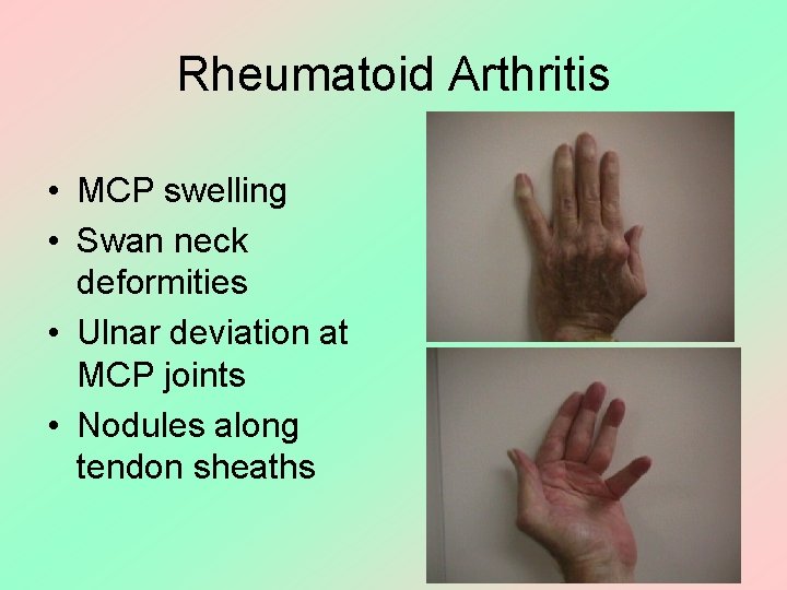 Rheumatoid Arthritis • MCP swelling • Swan neck deformities • Ulnar deviation at MCP