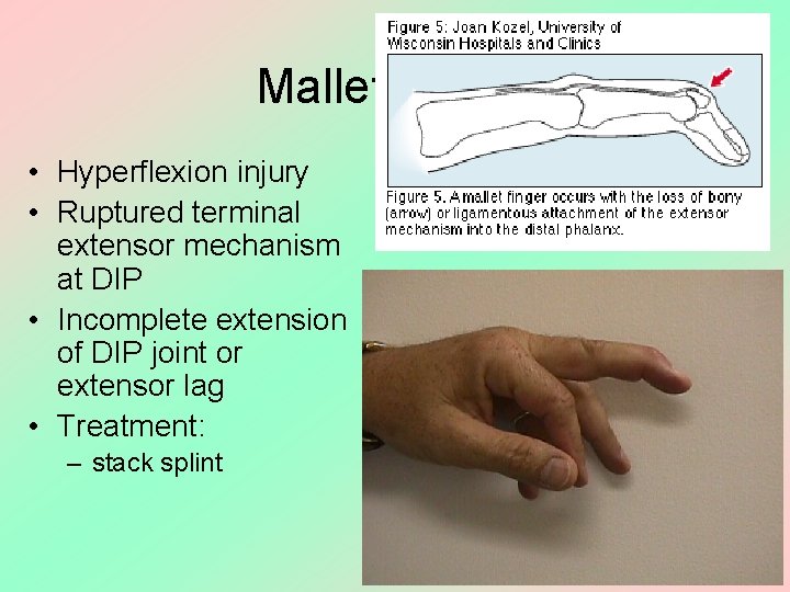 Mallet Finger • Hyperflexion injury • Ruptured terminal extensor mechanism at DIP • Incomplete
