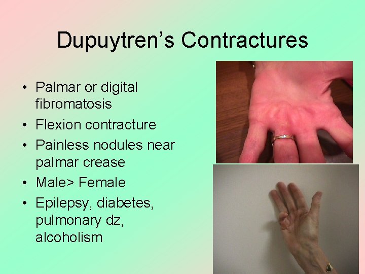 Dupuytren’s Contractures • Palmar or digital fibromatosis • Flexion contracture • Painless nodules near