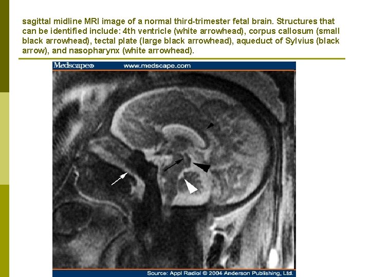 sagittal midline MRI image of a normal third-trimester fetal brain. Structures that can be