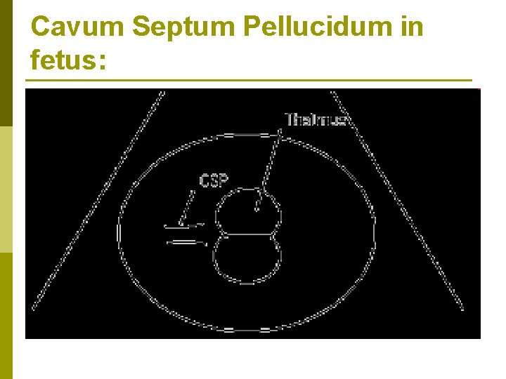 Cavum Septum Pellucidum in fetus: 