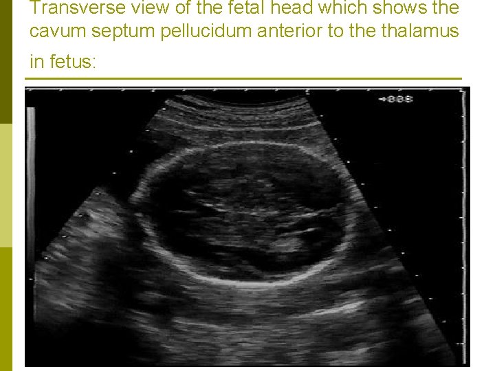 Transverse view of the fetal head which shows the cavum septum pellucidum anterior to