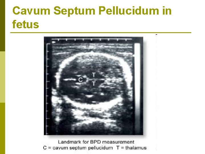 Cavum Septum Pellucidum in fetus 