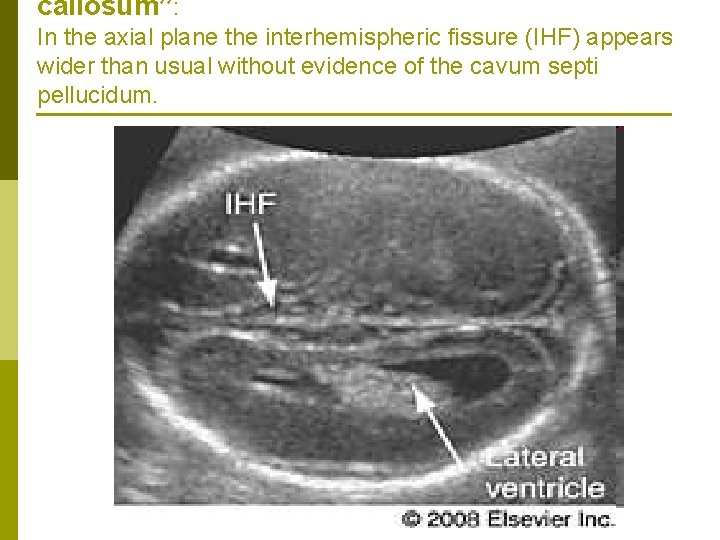 callosum”: In the axial plane the interhemispheric fissure (IHF) appears wider than usual without