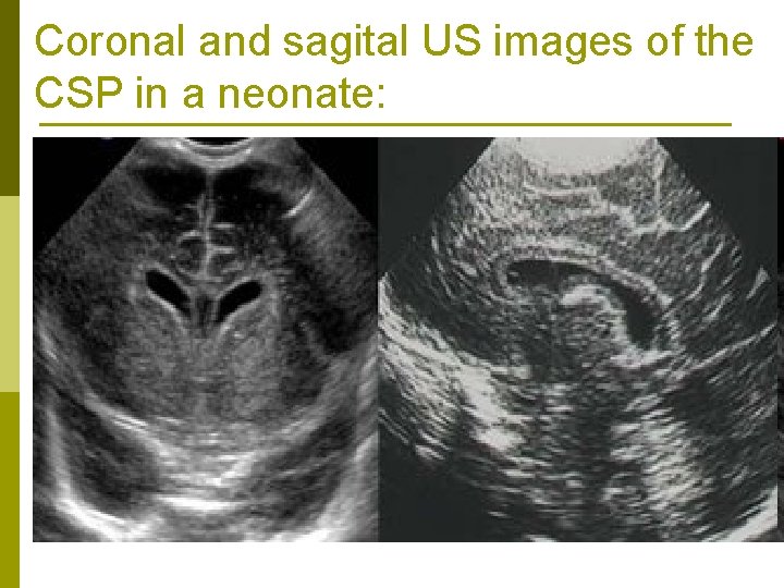 Coronal and sagital US images of the CSP in a neonate: 