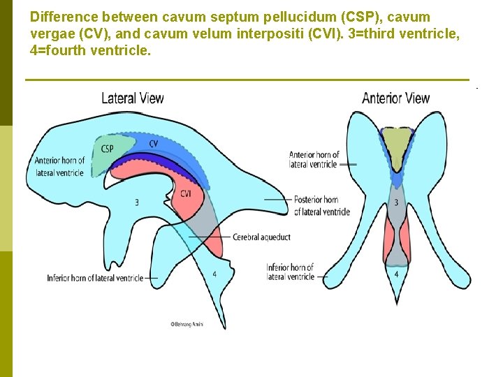 Difference between cavum septum pellucidum (CSP), cavum vergae (CV), and cavum velum interpositi (CVI).