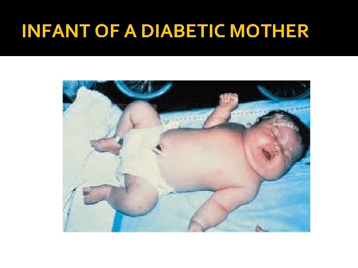 INFANT OF A DIABETIC MOTHER 