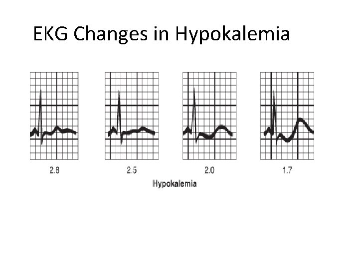 EKG Changes in Hypokalemia 