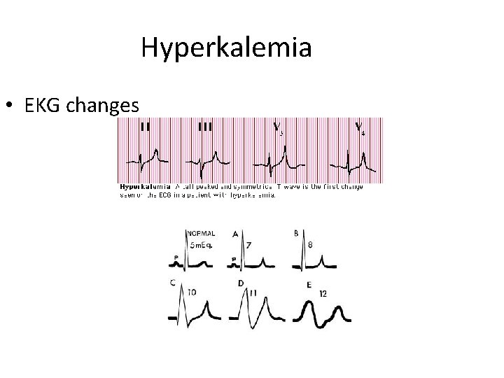 Hyperkalemia • EKG changes 