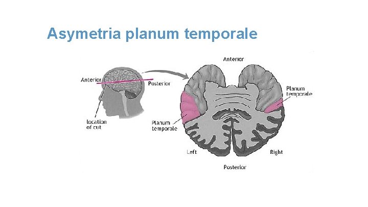 Asymetria planum temporale 