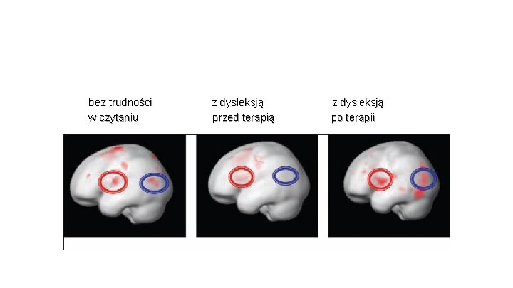 bez trudności w czytaniu z dysleksją przed terapią z dysleksją po terapii 