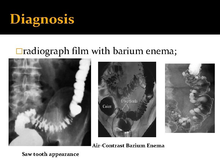 Diagnosis �radiograph film with barium enema; Air-Contrast Barium Enema Saw tooth appearance 