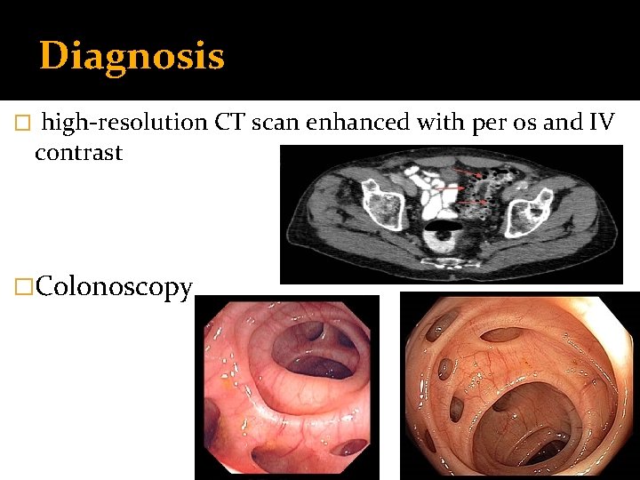 Diagnosis � high-resolution CT scan enhanced with per os and IV contrast �Colonoscopy 