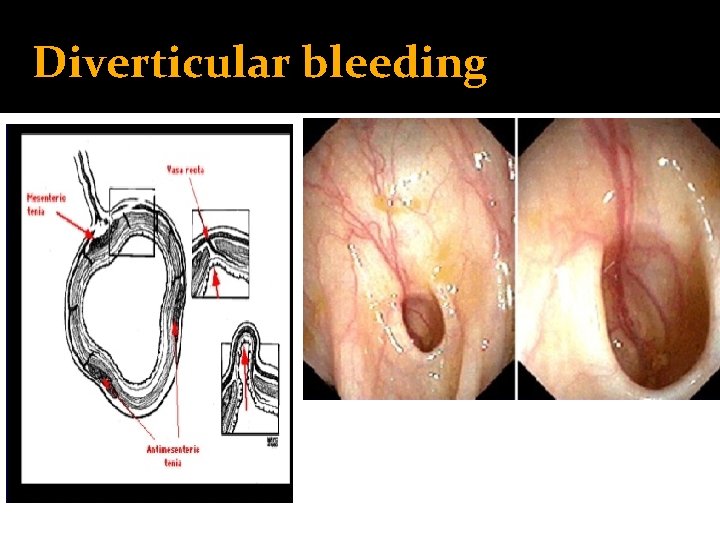 Diverticular bleeding 
