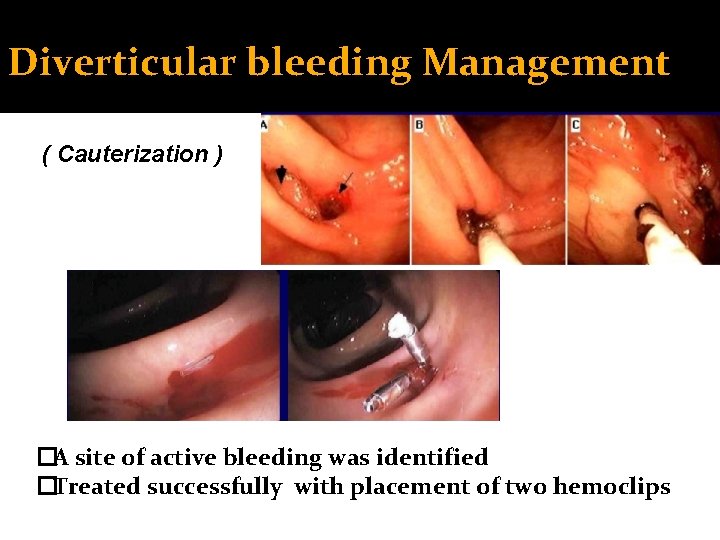 Diverticular bleeding Management ( Cauterization ) �A site of active bleeding was identified �Treated