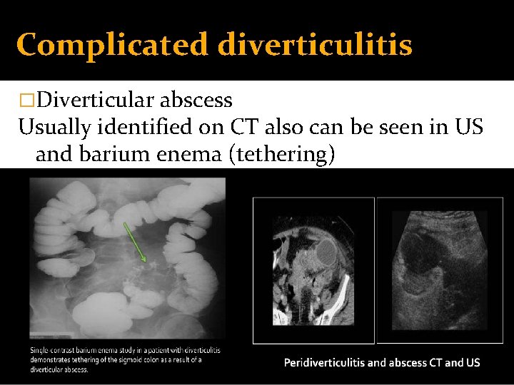 Complicated diverticulitis �Diverticular abscess Usually identified on CT also can be seen in US