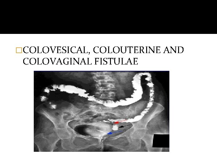 �COLOVESICAL, COLOUTERINE AND COLOVAGINAL FISTULAE 