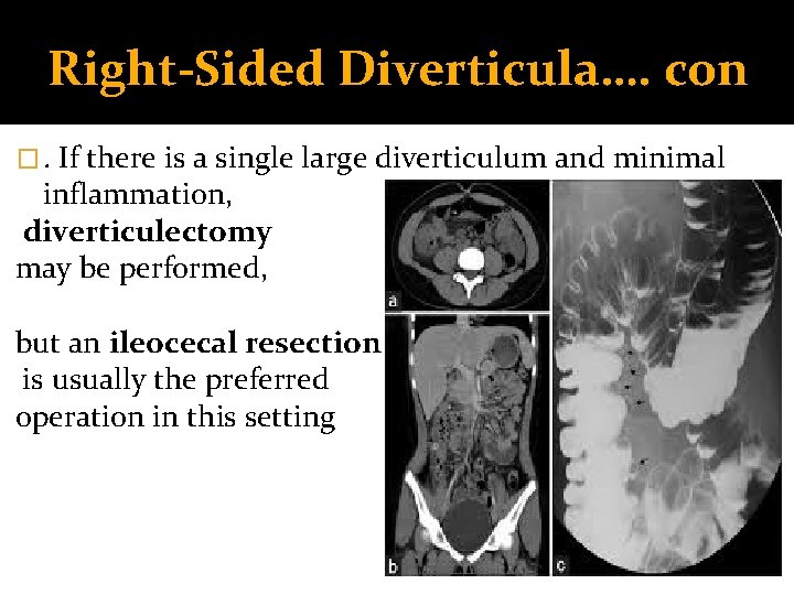 Right-Sided Diverticula…. con �. If there is a single large diverticulum and minimal inflammation,