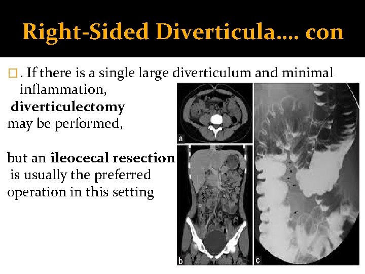 Right-Sided Diverticula…. con �. If there is a single large diverticulum and minimal inflammation, Right-Sided Diverticula…. con �. If there is a single large diverticulum and minimal inflammation,
