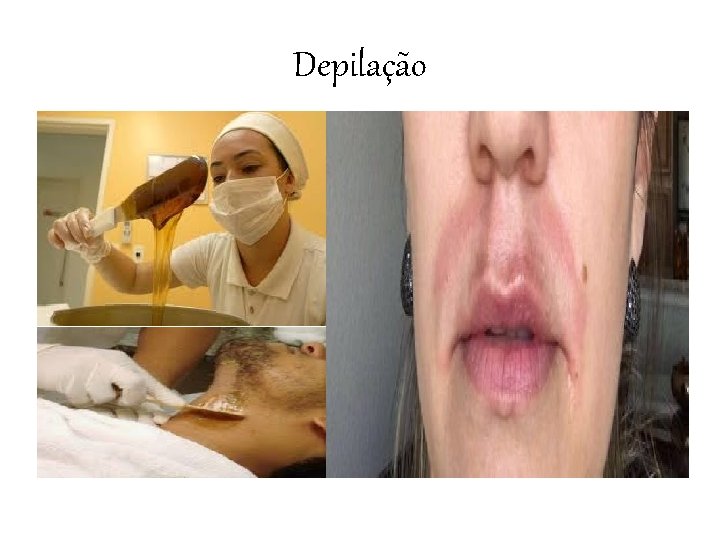 Depilação 