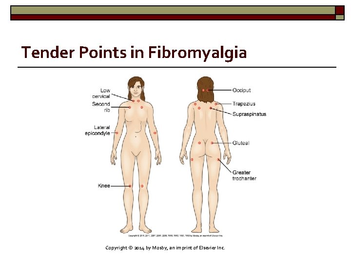 Tender Points in Fibromyalgia Copyright © 2014 by Mosby, an imprint of Elsevier Inc.