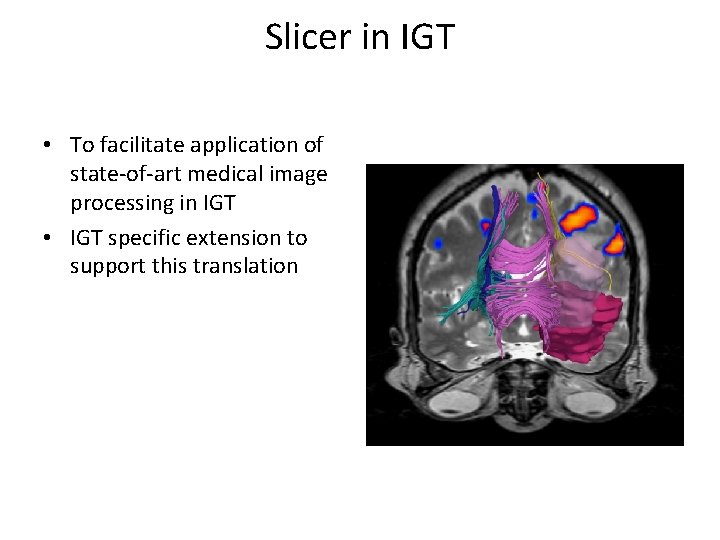 Slicer in IGT • To facilitate application of state-of-art medical image processing in IGT