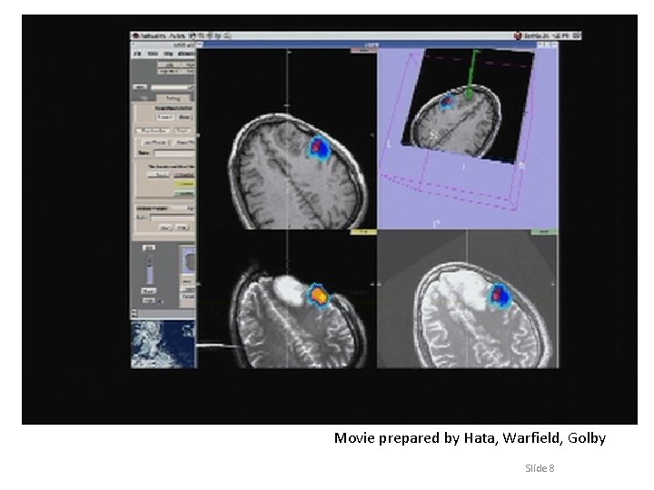 MR-guided neurosurgery • MRI-guided brain tumor surgery guided with f. MRI and diffusion tensor