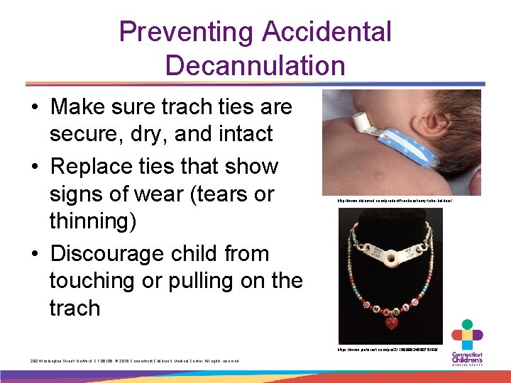 Preventing Accidental Decannulation • Make sure trach ties are secure, dry, and intact •