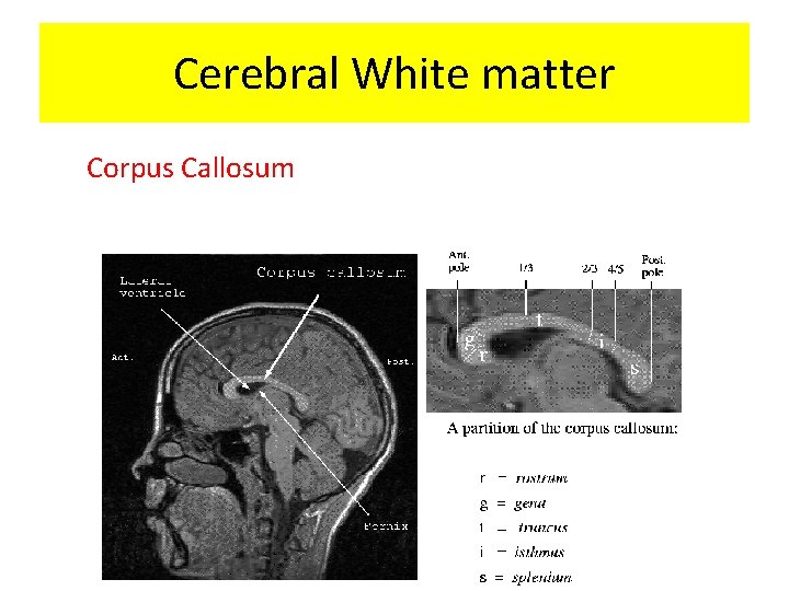 Cerebral White matter Corpus Callosum 