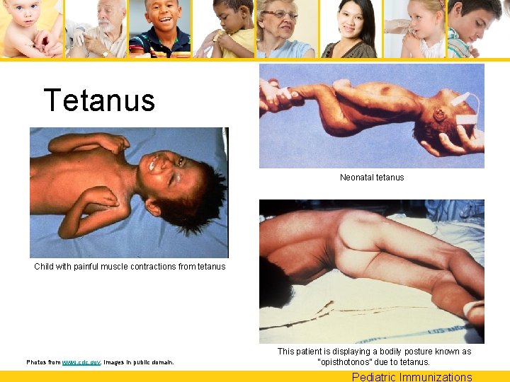 Tetanus Neonatal tetanus Child with painful muscle contractions from tetanus Photos from www. cdc.
