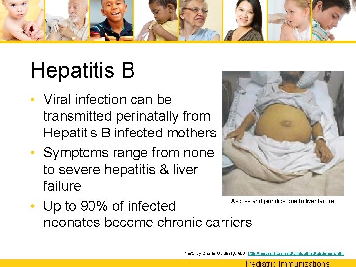 Hepatitis B • Viral infection can be transmitted perinatally from Hepatitis B infected mothers