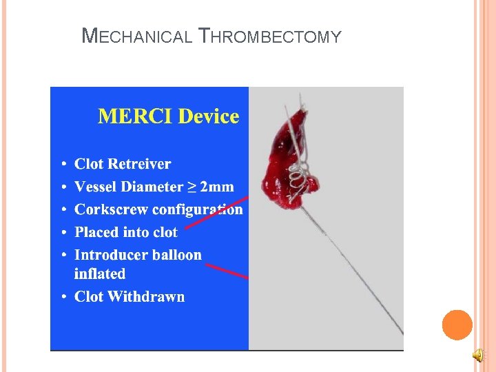 MECHANICAL THROMBECTOMY 