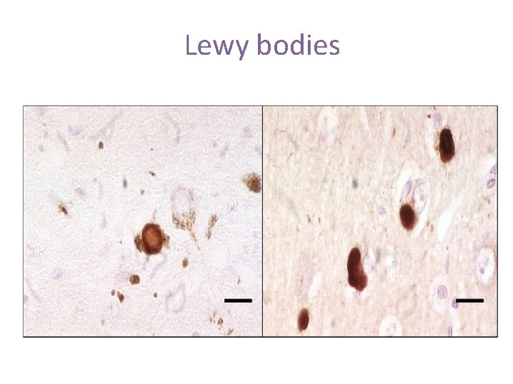 Lewy bodies 