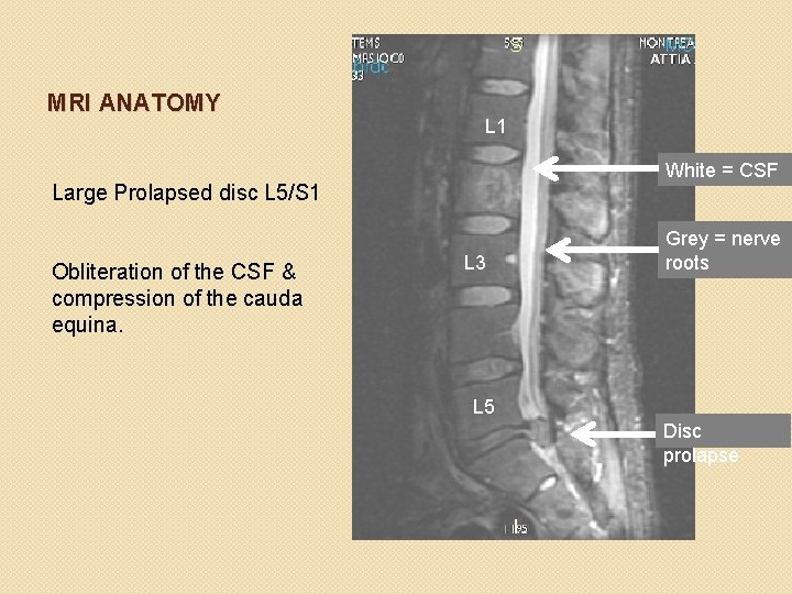 MRI ANATOMY L 1 White = CSF Large Prolapsed disc L 5/S 1 Obliteration