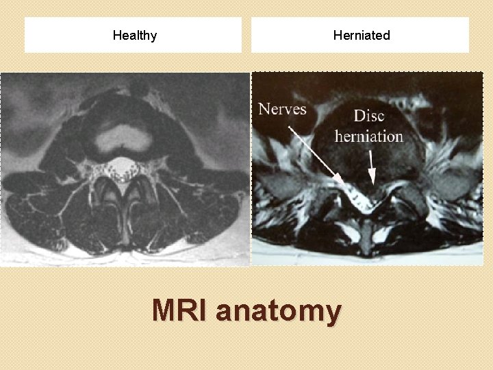 Healthy Herniated MRI anatomy 