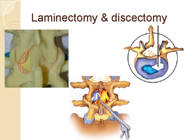 Laminectomy & discectomy 