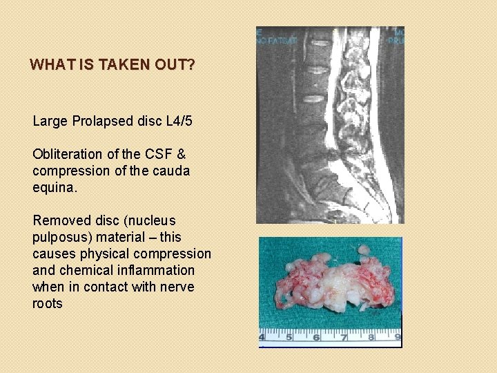 WHAT IS TAKEN OUT? Large Prolapsed disc L 4/5 Obliteration of the CSF &