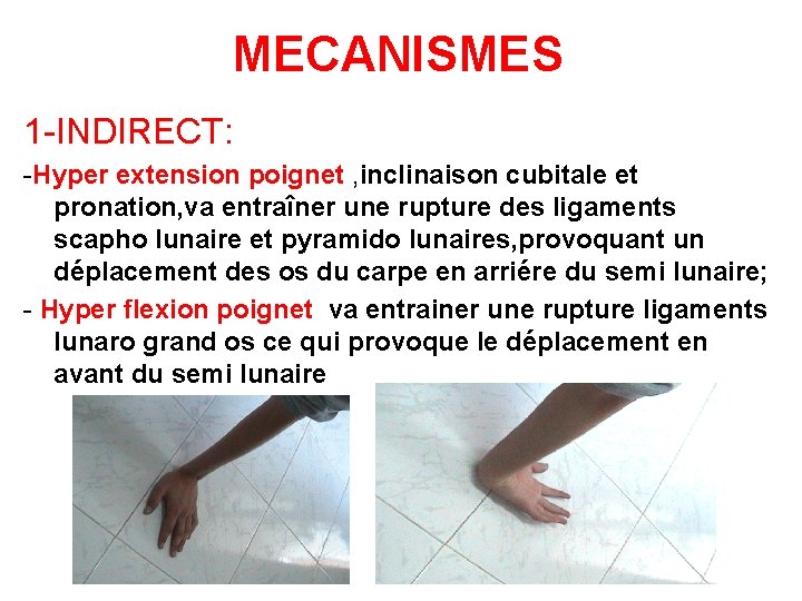MECANISMES 1 -INDIRECT: -Hyper extension poignet , inclinaison cubitale et pronation, va entraîner une